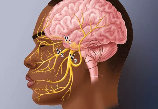Trigeminal nerve branches V1, V2, and V3 shown on a side profile of the head